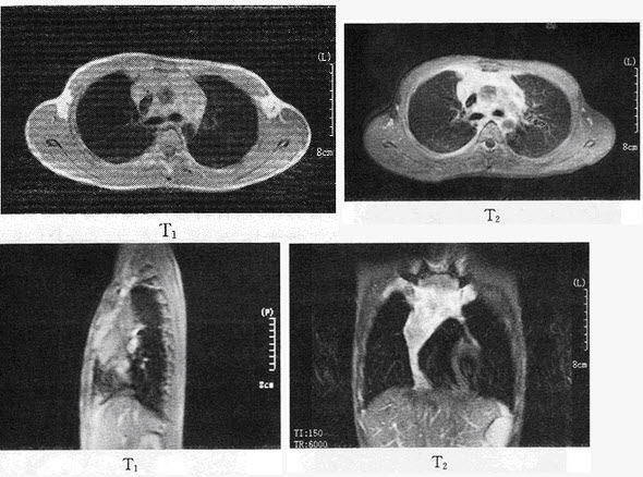 患者男，15岁。胸闷胸痛2个月，伴低热1个月余，患者行MR扫描图像如下，最有可能的诊断是（）