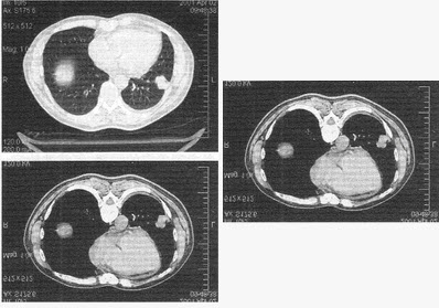 患者男，54岁。出现反复咳嗽咳痰3个月，CT图像如下，最有可能的诊断是（）