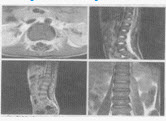 女，9岁，背部隐痛，发热1月余，MRI检查如图，最可能的诊断是（）.