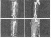 男，18岁，右股骨肿瘤术后，出现大腿中段疼痛，夜间尤甚，结合CT图像，最可能的诊断是（）.