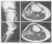 女，21岁，右膝痛二月，结合图像，最可能的诊断是（）.