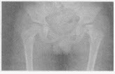 男，6岁，左髋关节跛行2月余，根据所示图像，最呵能的诊断是（）.