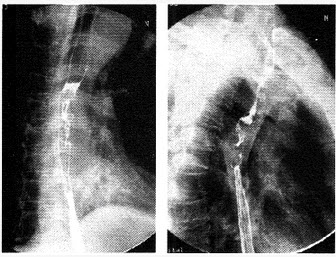 患者男，58岁。吞咽困难2个月余，X线图像如下，最有可能的诊断是（）