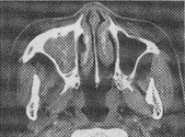患者，女，51岁，鼻塞、涕中少量血丝伴头昏、耳鸣2个月。行鼻窦CT平扫如下图：对本病钙化的显示较为敏