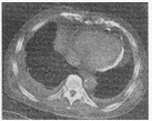 本病增强扫描较特征性的CT表现为（）.