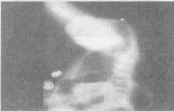 婴儿出生后无胎粪，哭闹，腹胀，无肛门。影像检查如图，最可能的诊断为（）