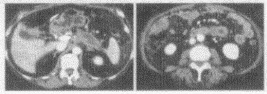 结合图像，关于该胰腺癌患者，无法手术切除的征象是（）