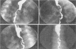 男，78岁，进行性吞咽困难1月余，结合图像，最可能的诊断为（）