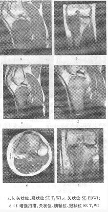 男，16岁，左膝部肿痛2周，不发热。结合左膝关节MRI平扫和增强扫描片，最可能的诊断为（）.