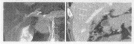 根据所提供的CT增强扫描时相的表现图像，最不可能的诊断为（）