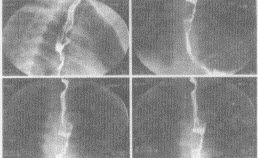 女，56岁，进行性吞咽困难2月，伴胸骨后针刺感入院，结合图像，最可能的诊断为（）