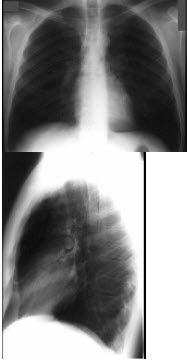 在哮喘急性发作的病程中患者出现颈部皮下气肿，胸片见图。说明此患者有下列哪一种并发症存在()