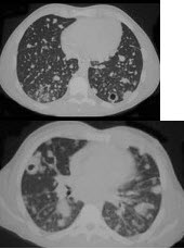 男，32岁，咳嗽，咳脓痰伴发热、胸痛一月余，抗感染治疗不见好转，PPD(-)，结合CT图像，最可能的