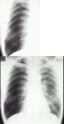 男性，34岁，突感胸部不适，X线检查如图最可能的诊断是()