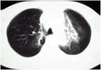 淋巴瘤患者放疗后3个月出现气急咳嗽，CT如图，应考虑为()