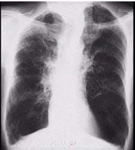 男，65岁，呼吸困难伴胸闷，胸片结果如图，最可能的诊断为()