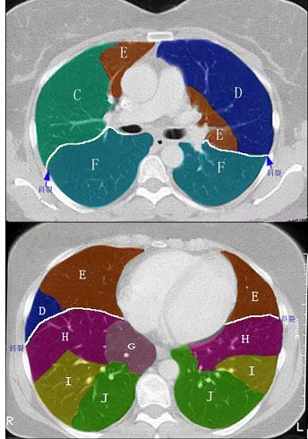 结合肺段模式心室层面(如图)，选出右肺上叶的组成()