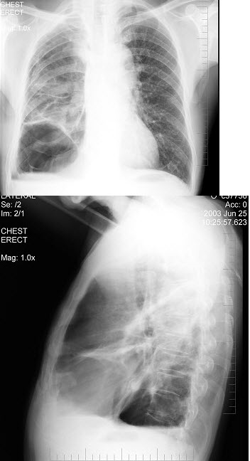 男性患者，62岁，常感胸闷、气逼，X线检查如图，最可能的诊断是()