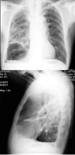 男性，62岁，常感胸闷、气逼，X线检查如图，最可能的诊断是()