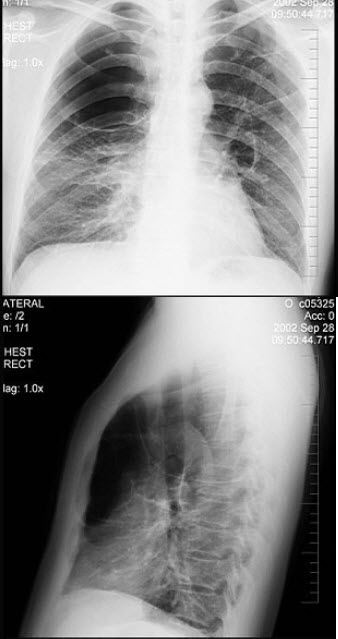 患者48岁，男性，常感胸闷气逼，近1个月渐加重，X线检查见图。最合适的诊断是()