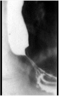 女性病人，20岁，间歇性吞咽困难3年，有时进流质即十分困难，X线检查钡造影如图所示，最可能的诊断是（