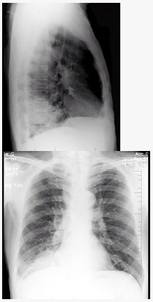 男性，62岁，咳嗽、胸痛一月，X线检查如图，最佳的诊断是（）