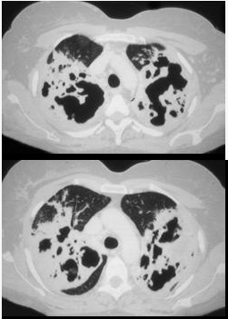 一养鸽女，48岁，发热，咳嗽，咳脓痰带血半月余，请结合CT检查选出最可能的诊断（）