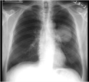 胸片如图所示，这种典型的X线征象以下列哪种疾病可能性最大（）