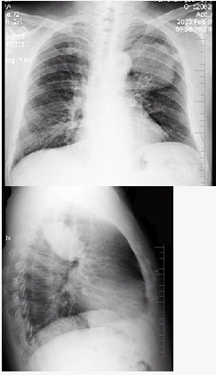 男性，70岁，因胸痛就诊，不咳嗽、发热，X线检查如图，最可能的诊断是（）