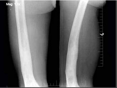 男，58岁，右大腿酸痛，弯曲变形，有外伤史，右股骨摄片如图所示，最可能的诊断是（）