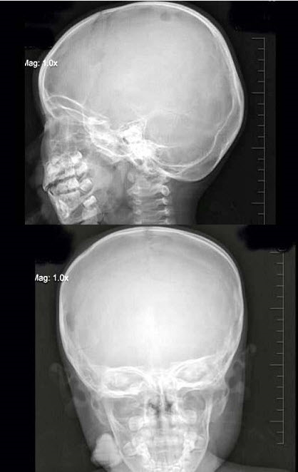 3岁，男，发热伴头顶部局限性疼痛1周，右额顶部可见局限性骨缺损，最可能的诊断是（）