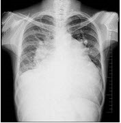 47岁女性患者，诊断风湿性二尖瓣狭窄3年余，近来呼吸困难，咳泡沫痰，拍胸部正位片如图所示，下列关于肺
