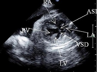 胎儿心脏超声检查如图，最可能的诊断是（）。[图]A. 法四B...	胎儿心脏超声检查如图，最可能的诊