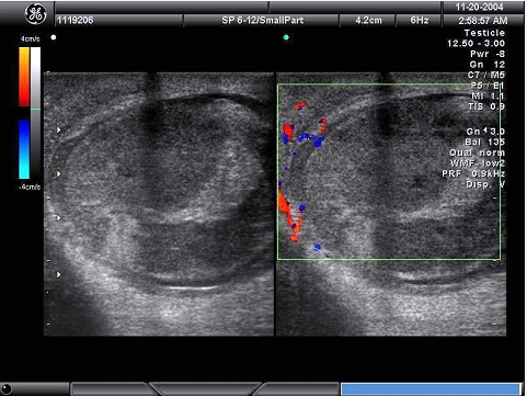 某男，因左阴囊疼痛不适数日，B超检查声像图如下，根据彩色声像图及血流特征，最可能的诊断为（）。