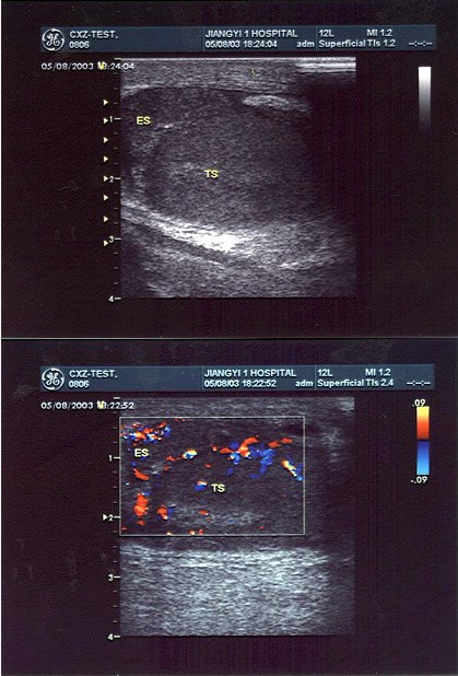 某患者阴囊部疼痛不适，超声声像图如下，最可能的诊断为（）。