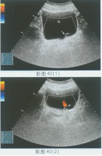 临床资料：男，75岁，自述下腹部不适。超声综合描述：膀胱三角区左输尿管开口处可见直径1.2cm圆形无