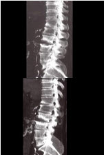 男，65岁，腰背部疼痛1月余，结合图像，最可能的诊断是（） 