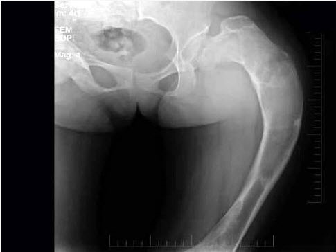 女，17岁，左髋部酸胀不适半年，骨盆正位片如图所示，最可能的诊断是（）