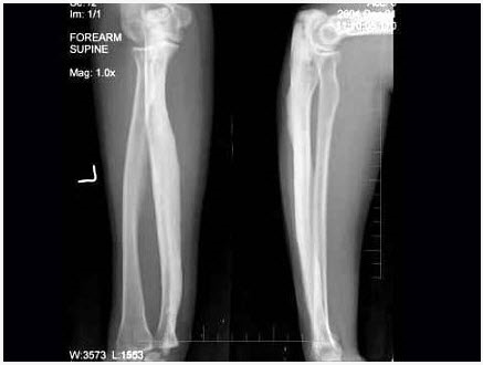 30岁，女，因左前臂酸胀不适1年，活动可，左前臂正侧位片如图所示，最可能诊断是（）