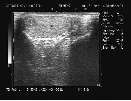 某患者五日前阴囊碰伤，现感右侧阴囊不适，超声声像图如下，最可能的诊断为（）。