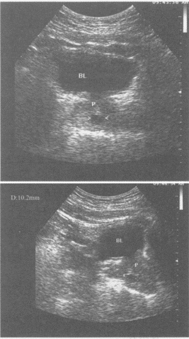 临床资料：男，22岁，自述下腹部不适。化验检查：尿常规正常。超声综合描述：前列腺形态大小正常，中部可