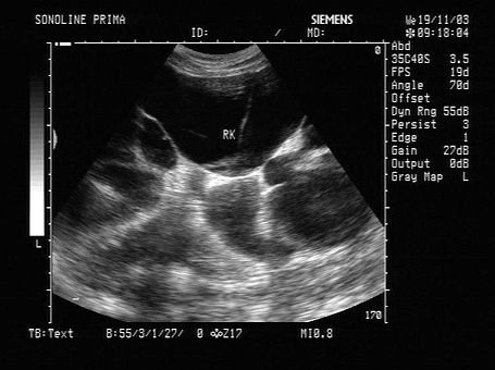 根据超声图像所示，该病例为哪型肾积水（）。