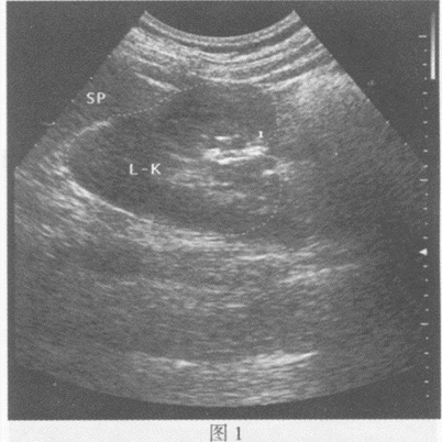 临床资料：女，32岁，常规体检。超声综合描述：左肾形态失常，纵切呈"C"形（图1、图2），肾门指向右