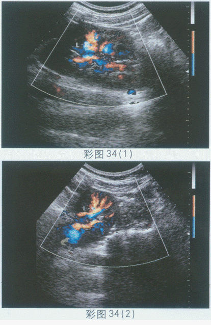 临床资料：女，32岁，常规体检。超声综合描述：左肾形态失常，纵切呈"C"形（图1、图2），肾门指向右