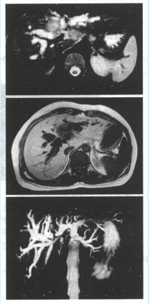 患者，男，74岁。肝区偶感不适，腹胀、消瘦乏力，行MRI检查，如图。	肝门区胆管癌（Klatskin