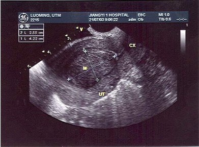 某患者月经量多就诊，经阴道超声声像图如下，最可能的超声诊断为（）。