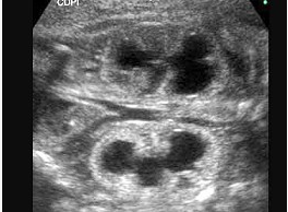 图为孕34周的胎儿声像表现。根据图像特点，最可能的诊断为（）。