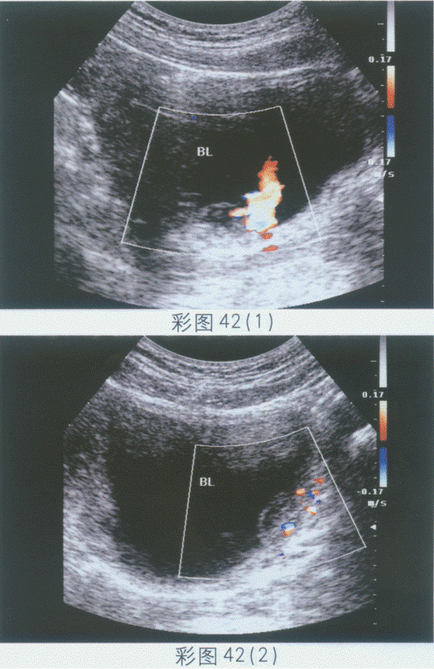 临床资料：女，41岁，血尿待查。超声综合描述：右输尿管膀胱开口处膀胱壁可见2.5cm×1.3cm中等