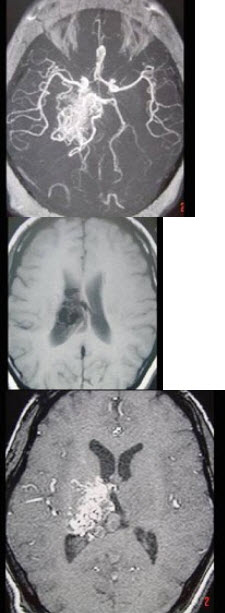 女性，40岁，头晕、头痛两年余，MR检查如图所示，请选择的最可能诊断()