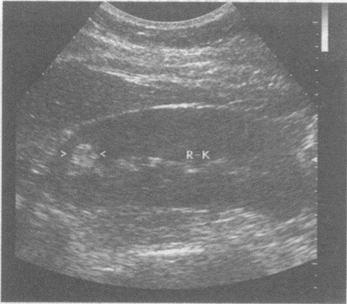 临床资料：女，27岁，常规体检。超声综合描述：右肾形态、大小正常，上极实质部可见1.2cm×1.2c